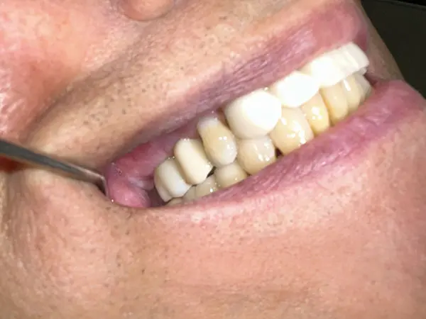 Patient Implants