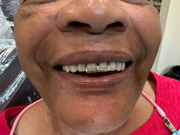 Custom Denture Patient